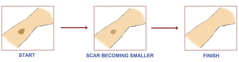 Scar Becomes Smaller